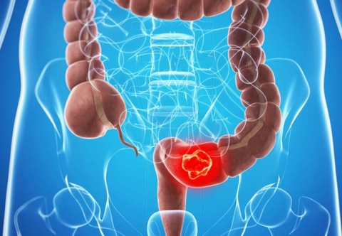 Tổng quan bệnh ung thư đại tràng